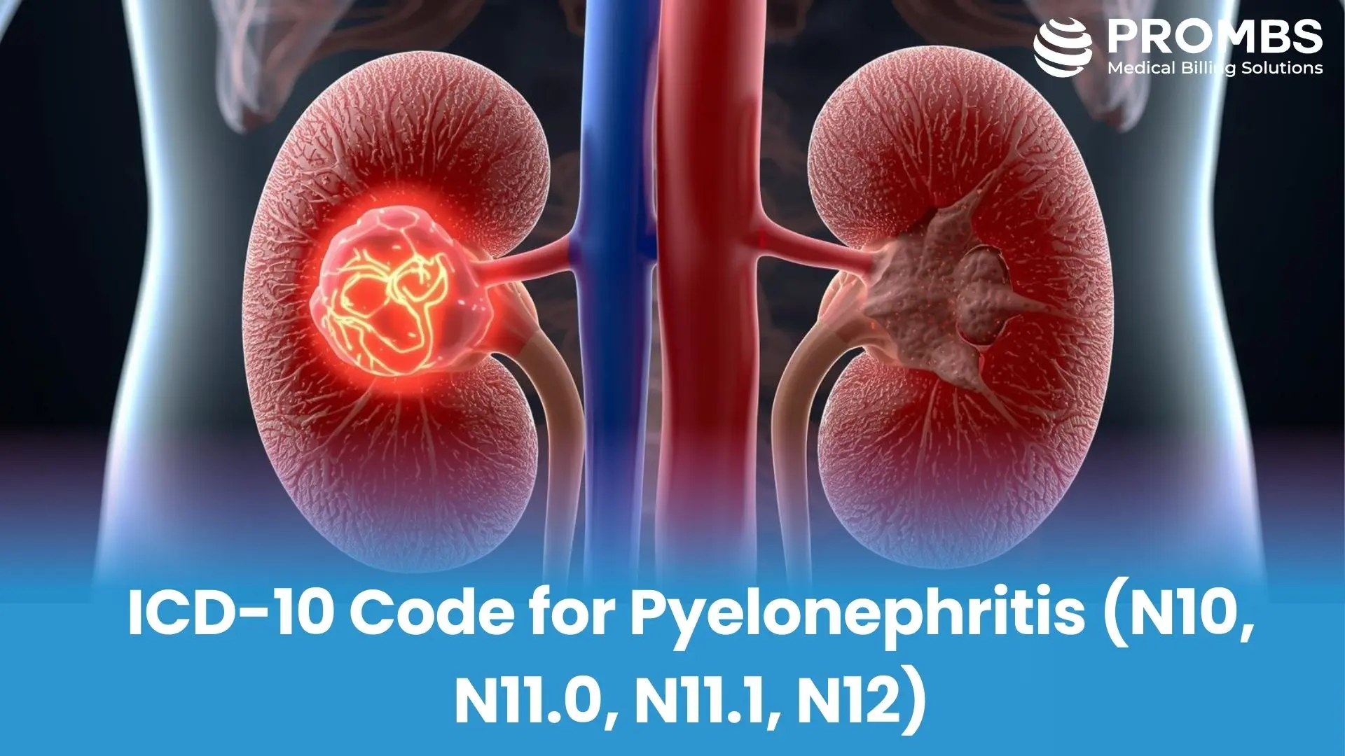 ICD-10 Code for Pyelonephritis